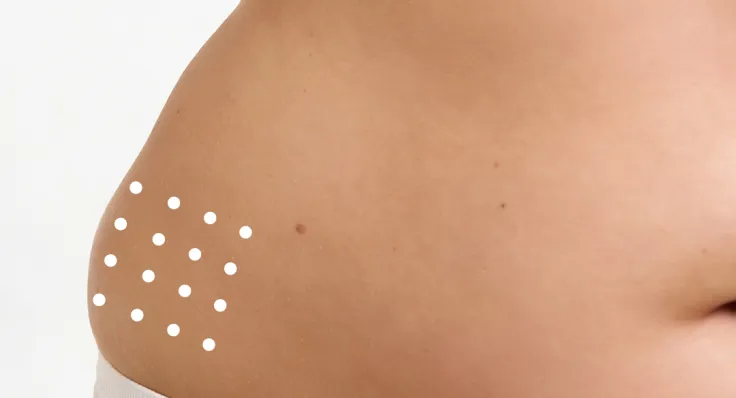 Anwendungsmuster – Seitlicher Bauch